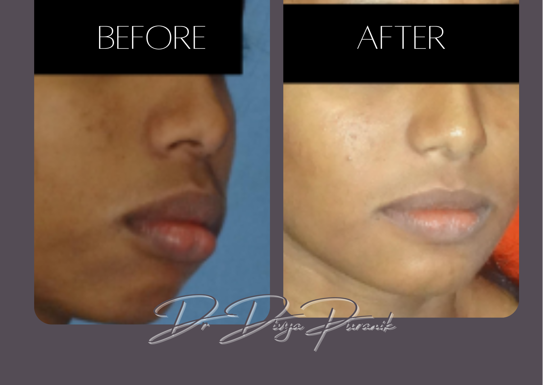 jaw before & after image