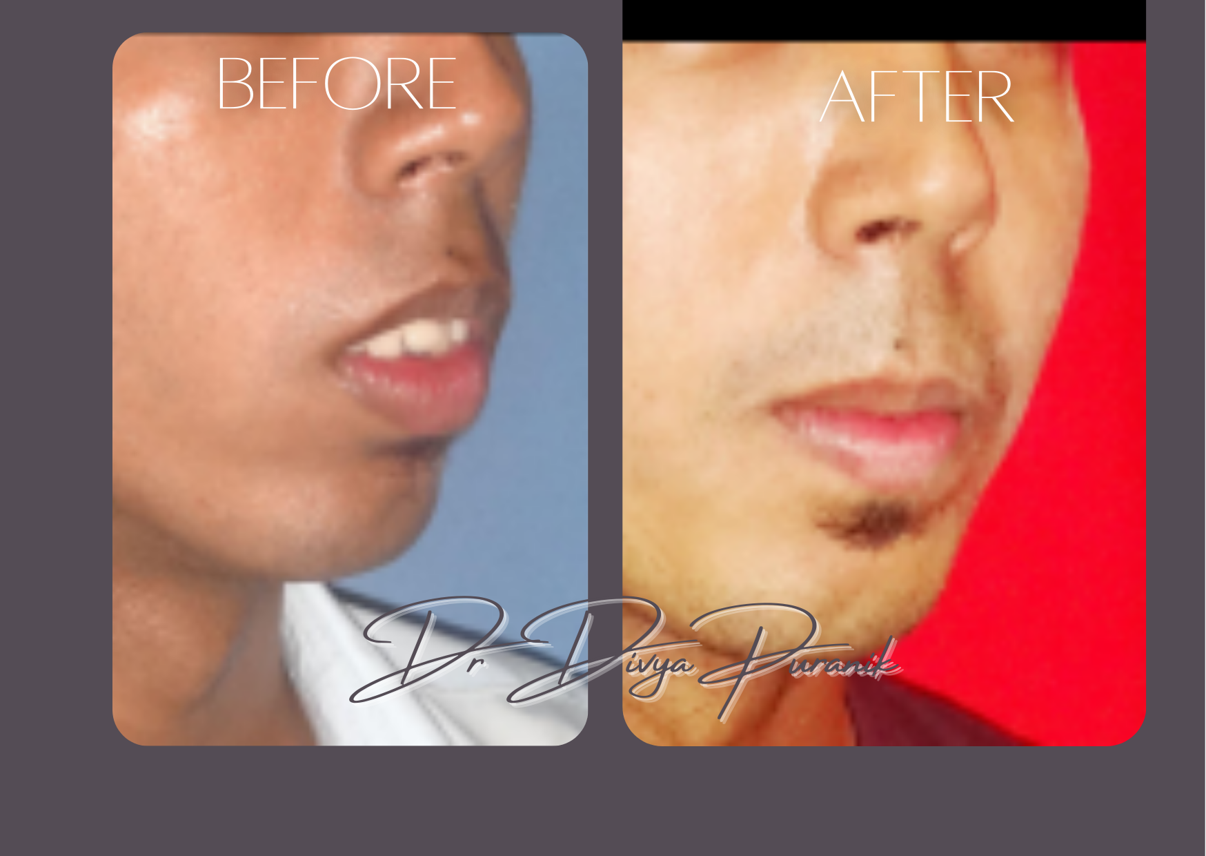 jaw before & after image