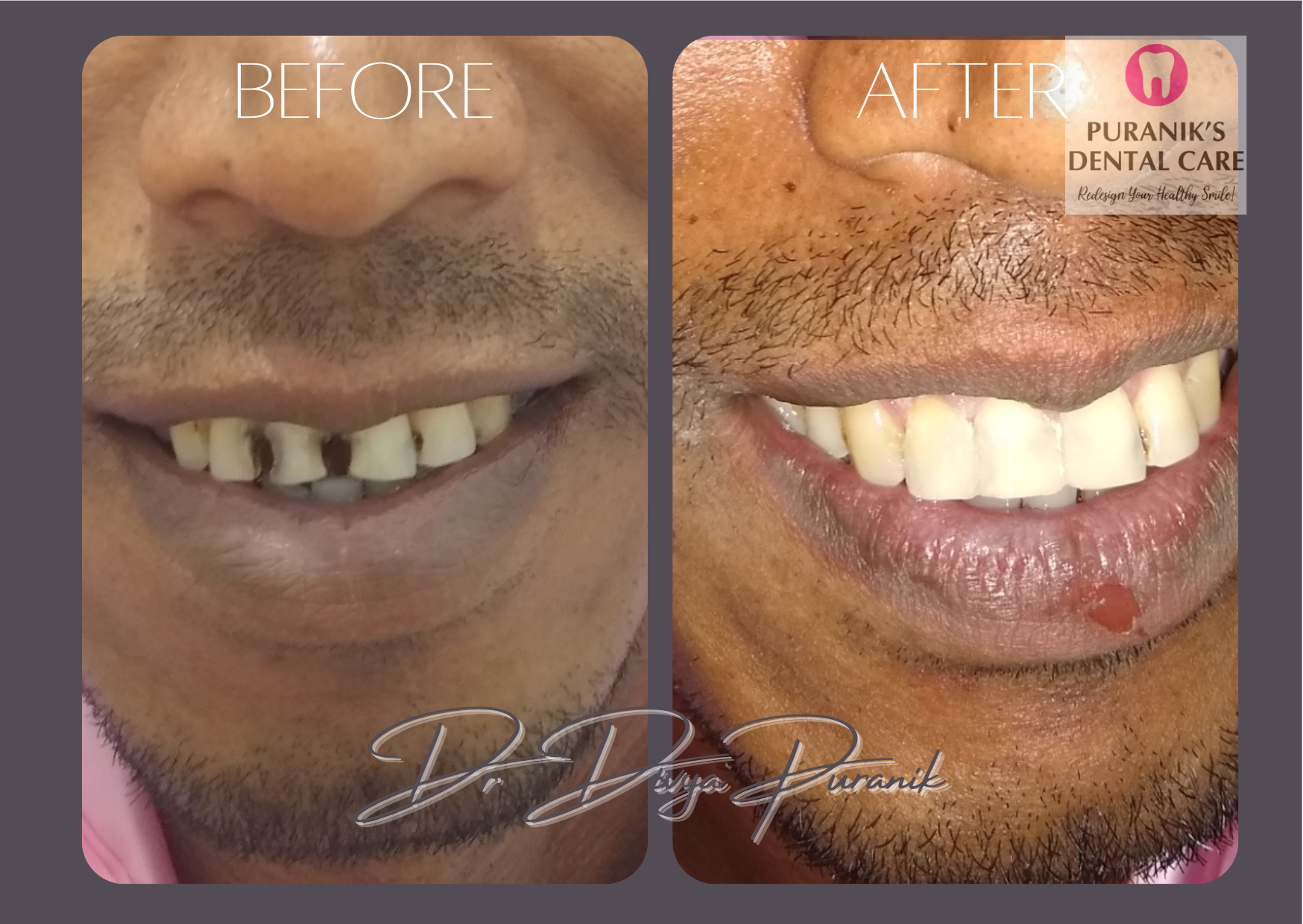 damage teeth before & after