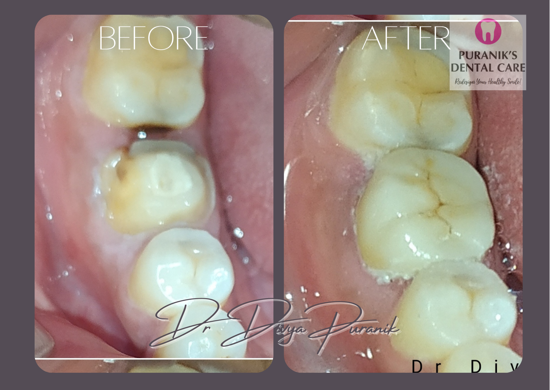 damaged tooth before & after