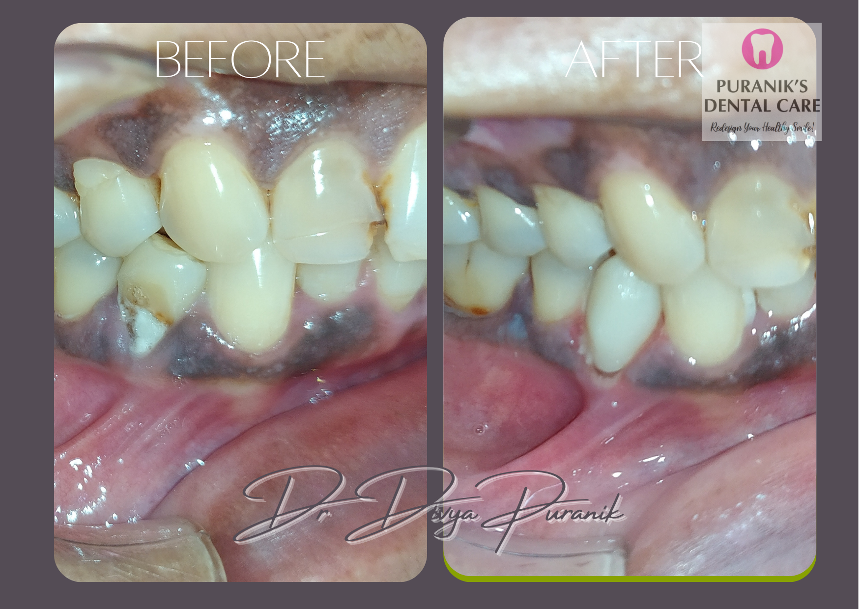 yellow teeth before & after image