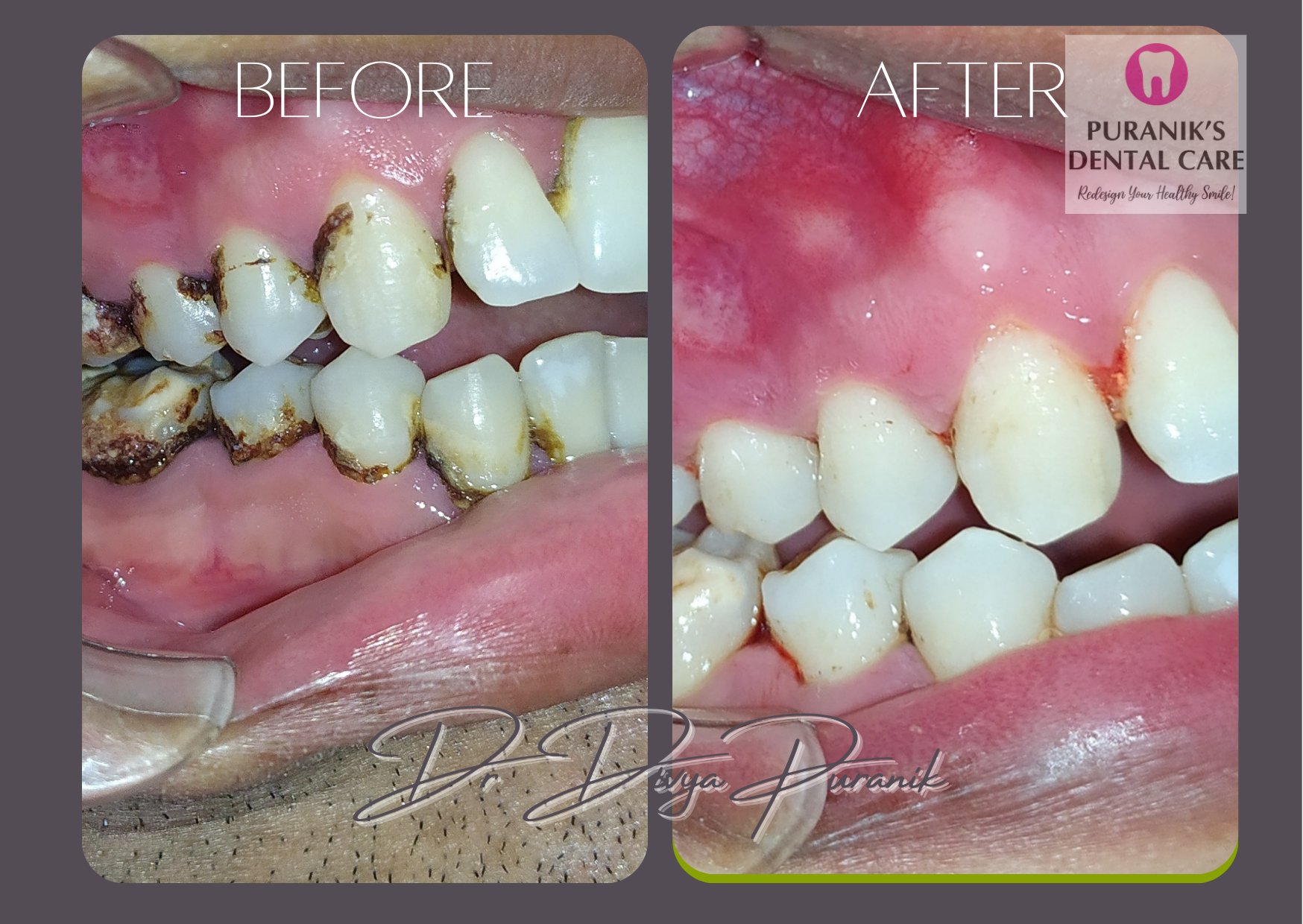 tooth filling before & after