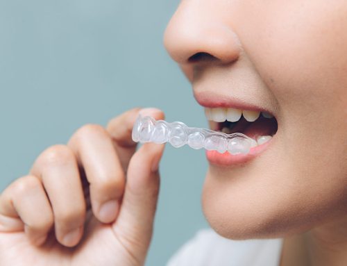 How Do Invisible Aligners Work?