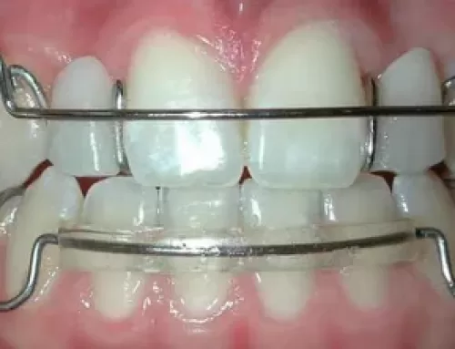 How To Take Care Of Your Orthodontic Retainers?