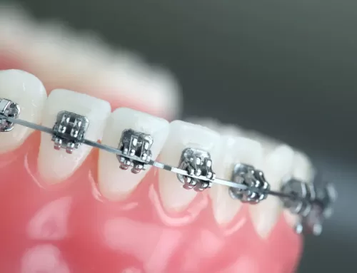 Affordable Metal Braces in Bangalore: Costs and Benefits